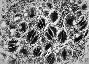 F,69y. | cystadenoma (Warthin tumor) … caruncula - (modified mitochondria in an autolysed sample) F,69y. | cystadenoma (Warthin tumor) … caruncula - (modified mitochondria in an autolysed sample)